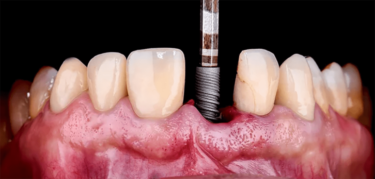 Implantologie guidée